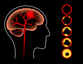 Ischaemic stroke, illustration