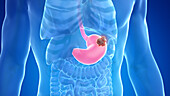 Stomach cancer, illustration