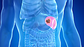 Spleen cancer, illustration