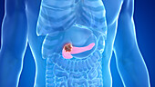Pancreas cancer, illustration