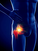 Man with a painful hip joint, illustration