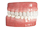 Clear dental aligner, illustration