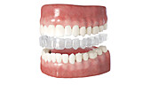 Clear dental aligner, illustration