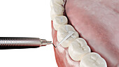 Dental fissure filling, illustration