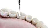 Dental fissure filling, illustration