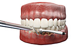 Dental pocket reduction, illustration