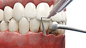 Dental pocket reduction, illustration