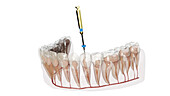 Root canal treatment, illustration