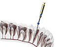 Root canal treatment, illustration