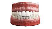 Dental veneers, illustration