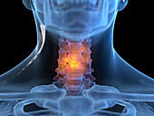 Inflamed neck, illustration