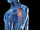 Painful thoracic spine, illustration