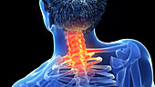 Painful cervical spine, illustration