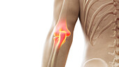 Painful elbow joint, illustration