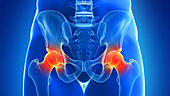 Painful hip joints, illustration