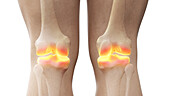 Painful knee joints, illustration