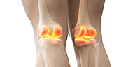 Painful knee joints, illustration