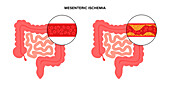 Mesenteric ischaemic, illustration