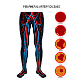 Peripheral artery disease, illustration