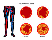 Peripheral artery disease, illustration