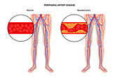 Peripheral artery disease, illustration