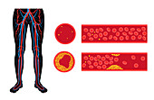 Peripheral artery disease, illustration