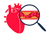 Atherosclerosis, illustration