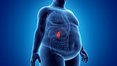 Obese man's gallbladder, illustration