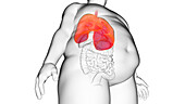 Obese man's lung, illustration