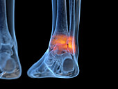 Inflamed ankle, illustration