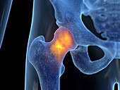 Inflamed hip joint, illustration
