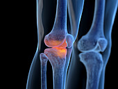 Inflamed knee joint, illustration