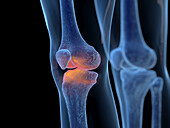 Inflamed knee joint, illustration