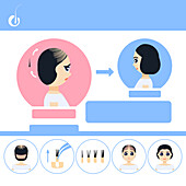 FUE hair transplantation in women, illustration