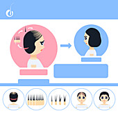 FUT hair transplantation in women, illustration