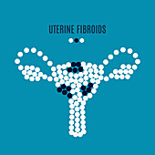Uterine fibroids, conceptual illustration