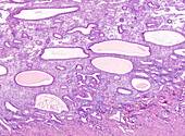 Nonatypical endometrial hyperplasia, light micrograph