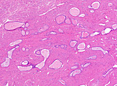 Endometrioid carcinoma, grade 1, light micrograph