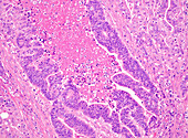 Endometrioid carcinoma with necrosis, light micrograph