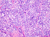 Endometrioid carcinoma, grade 3, light micrograph