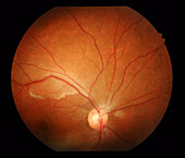 Retinal vasculitis, fundoscopy