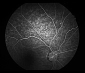 Retinal vasculitis, angiogram