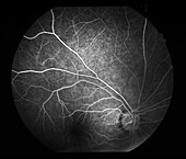 Retinal vasculitis, angiogram