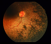 Pigmentary retinopathy, fundoscopy