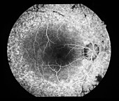Pigmentary retinopathy, angiogram