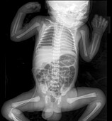 Four day old baby, X-ray