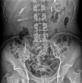Swollen kidney, X-ray