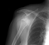 Dislocated right shoulder, X-ray