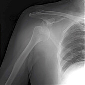 Dislocated right shoulder, X-ray