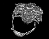 Fractured hyoid bone, 3D CT scan
